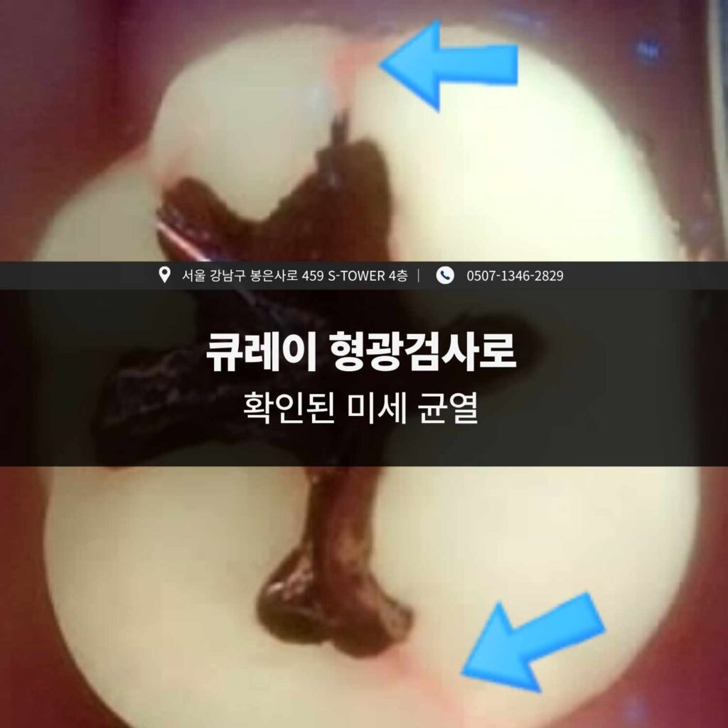 큐레이 형광검사로 확인된 금간 치아의 미세 균열