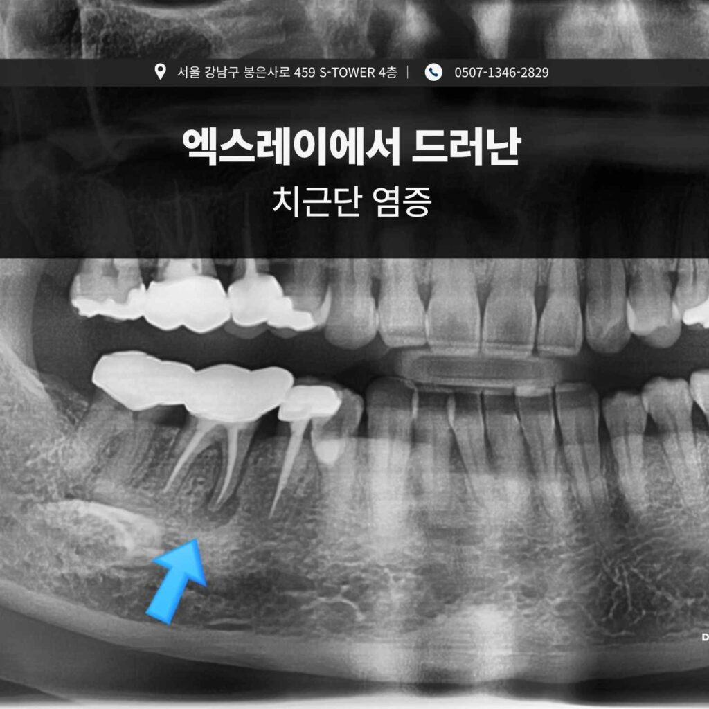 엑스레이에서 확인된 치근단 염증 J-Shape 병소