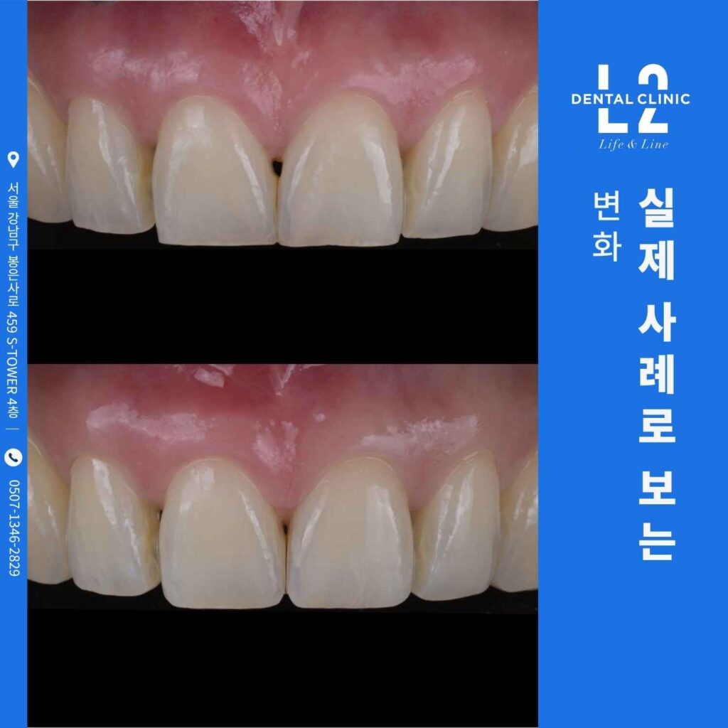 법랑질 성형술 시술 전후 비교 사진