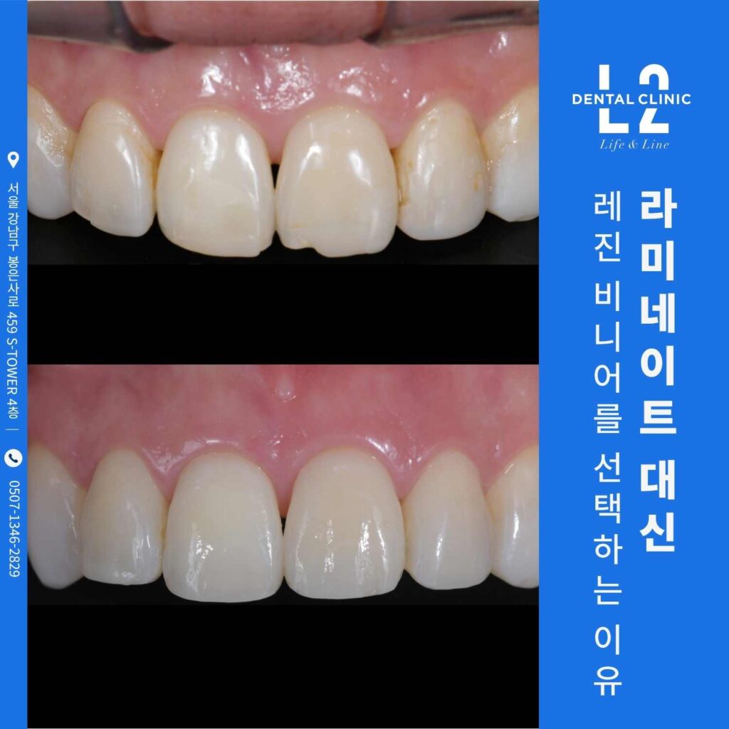 앞니 레진 비니어로 재형성한 치료 전후 비교 사진