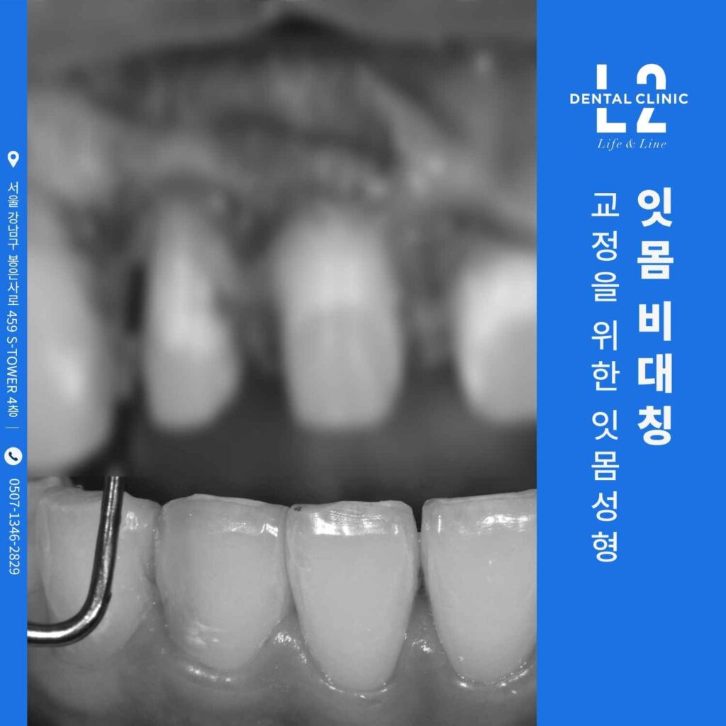 잇몸성형을 위해 치아 앞쪽에서 잇몸 높이를 측정하는 치과 기구 사용 장면