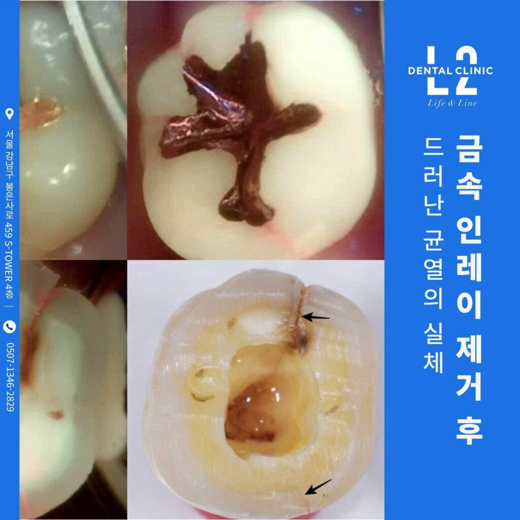 금속 인레이 제거 후 드러난 어금니 균열
