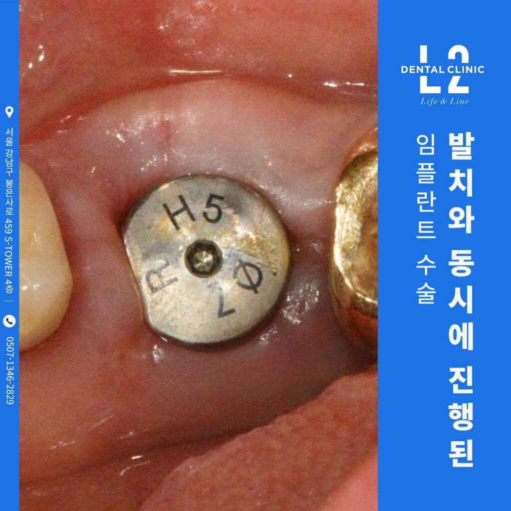 발치와 동시에 진행된 즉시 임플란트 수술