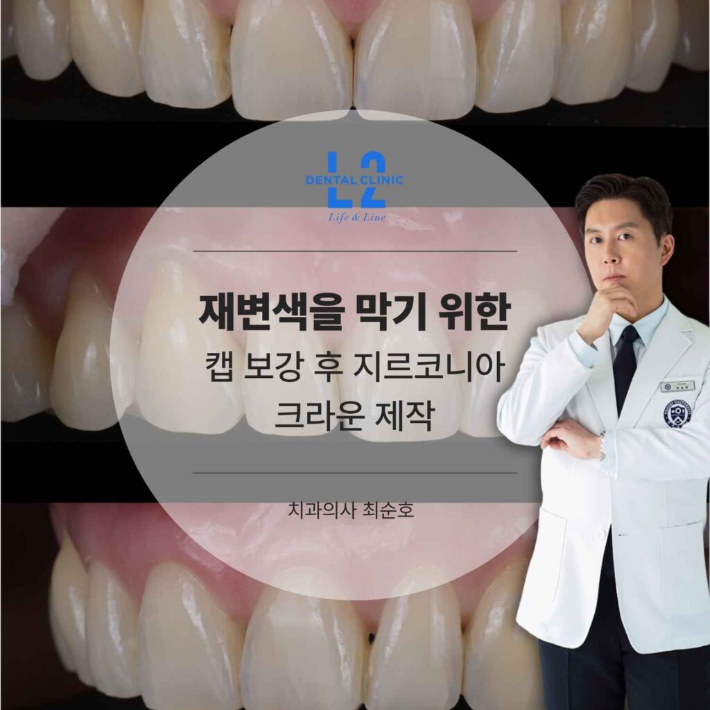 보강 캡 적용 후 지르코니아 크라운 제작 결과를 보여주는 치아 이미지와 의료진 사진