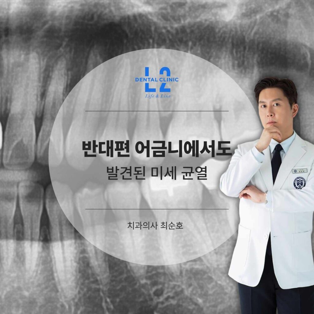 반대편 어금니에서 발견된 미세 균열