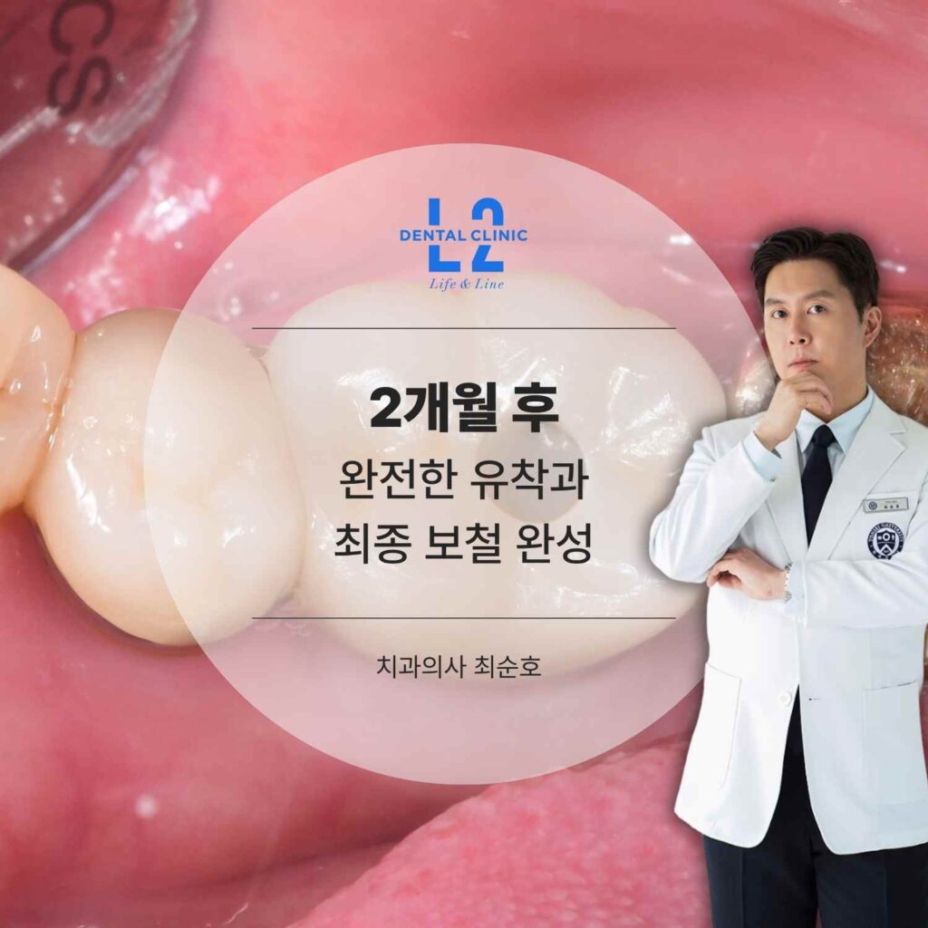 2개월 후 완전한 유착과 최종 보철 완성