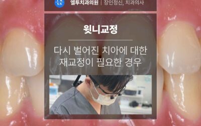 윗니교정, 다시 벌어진 치아에 대한 재교정이 필요한 경우