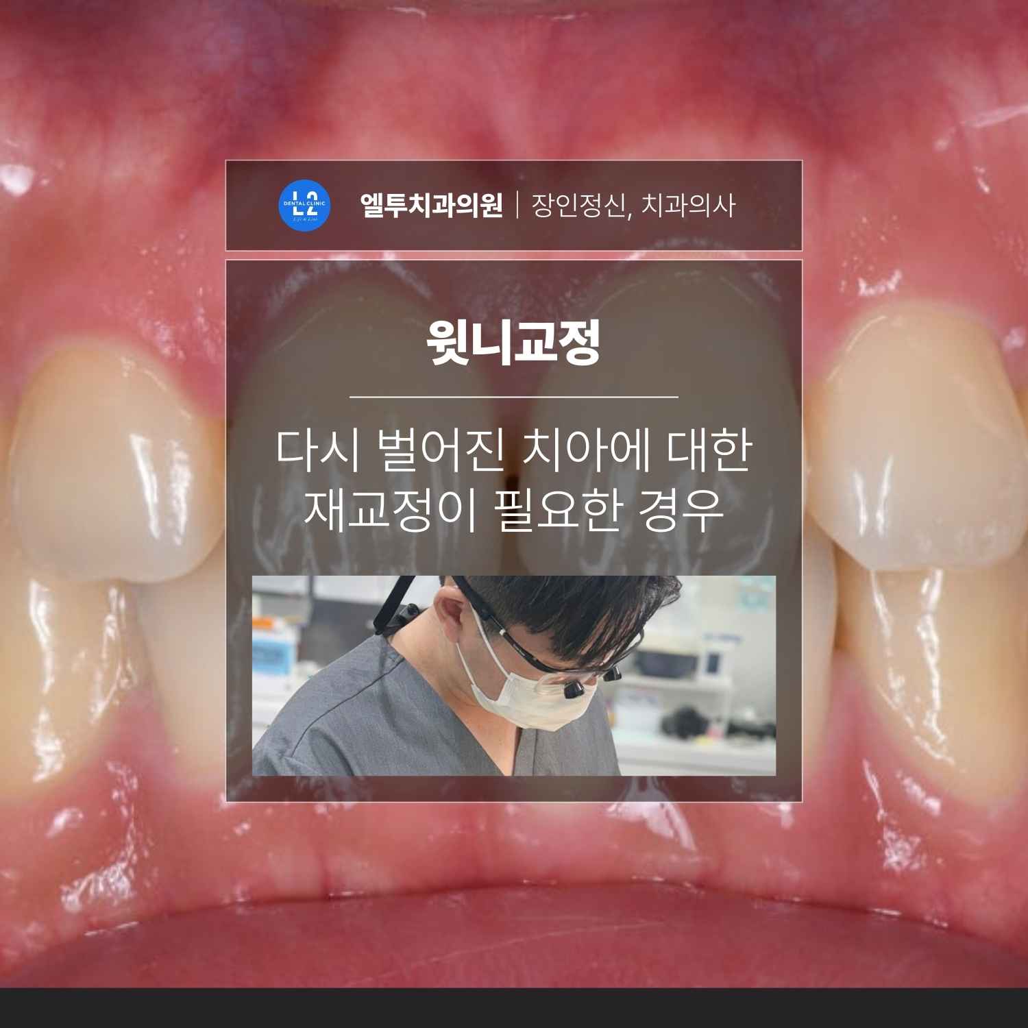 윗니교정 사례, 유지장치 탈락 후 다시 벌어진 앞니 재교정 치료