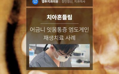 강남치과 치아흔들림 어금니잇몸통증 엠도게인 재생치료 사례