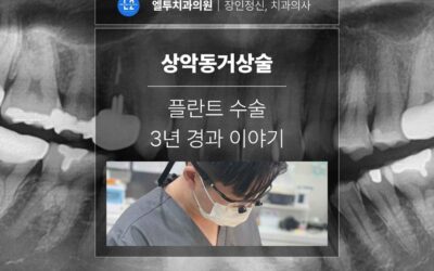 잠실치과 상악동거상술 임플란트 수술 3년 경과 이야기