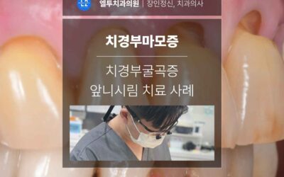 삼성동치과 치경부마모증·치경부굴곡증 앞니시림 치료 사례