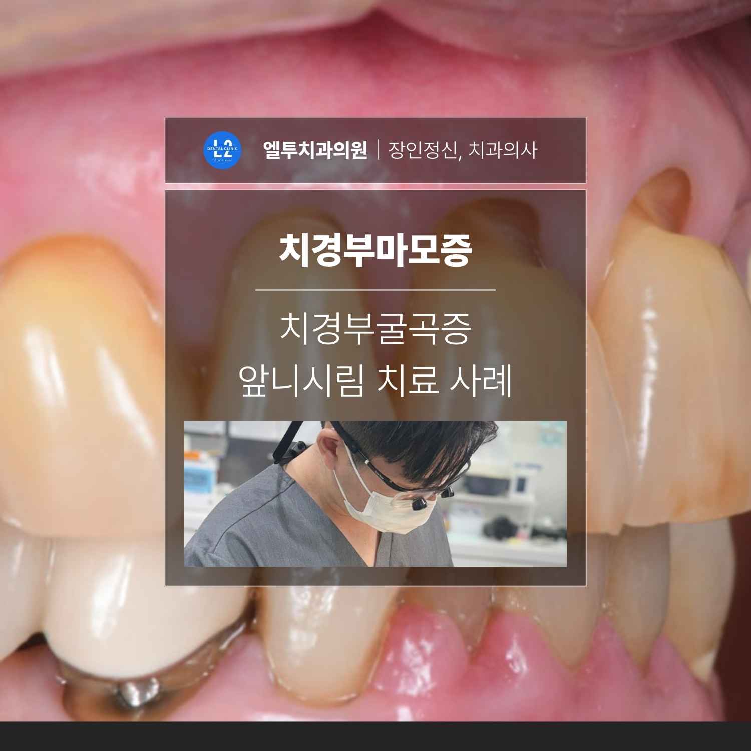 치경부마모증과 치경부굴곡증, 앞니시림 치료 사례를 소개하는 엘투치과 시술 안내 이미지