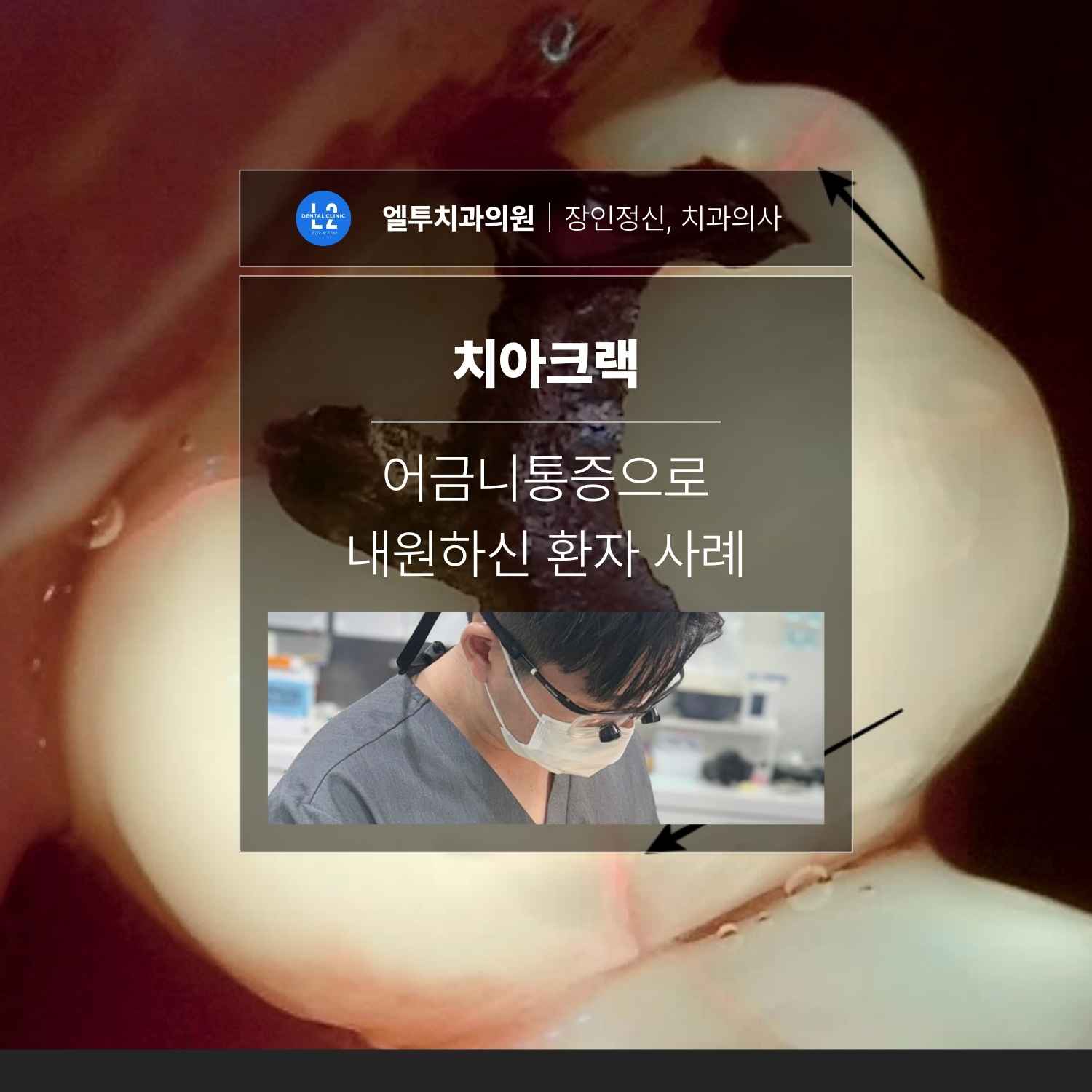 치아크랙 어금니통증 환자 사례 안내 치아크랙과 어금니통증 사례를 소개하는 대표 이미지로 균열된 치아와 진료 장면이 함께 나타난 사진