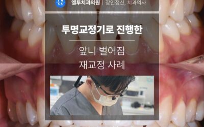 투명교정기로 진행한 앞니 벌어짐 재교정 사례