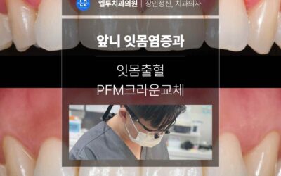 앞니 잇몸염증과 잇몸출혈 PFM크라운교체로 회복