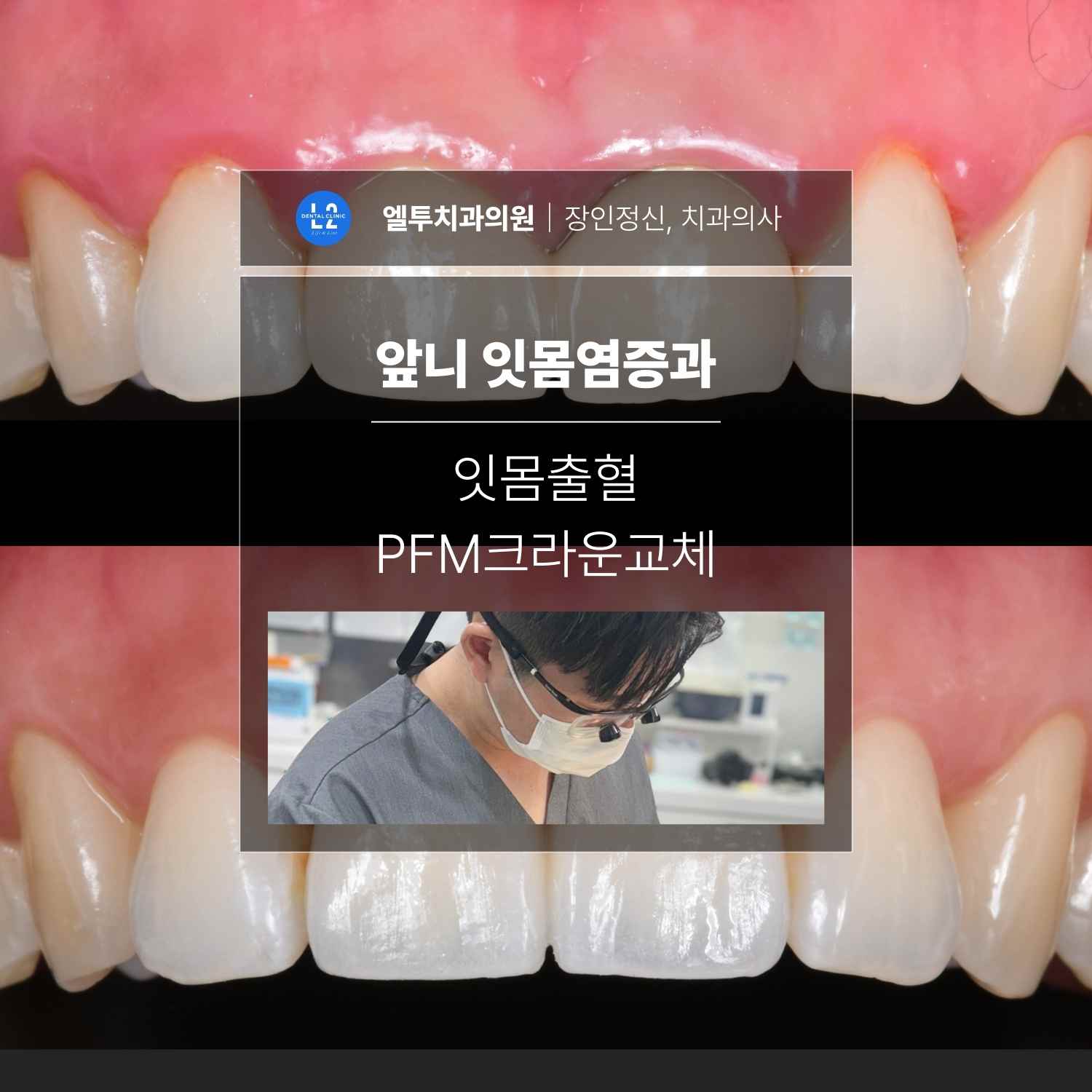 앞니 사진 위에 ‘앞니 잇몸염증과 잇몸출혈 PFM크라운교체’ 주제가 적힌 커버 이미지.