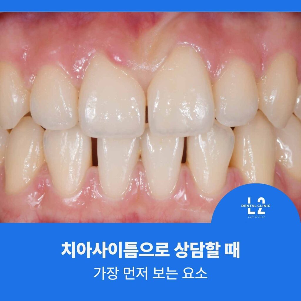 치아사이틈 상담 시 앞니 배열과 잇몸 상태를 확인한 구강 정면 사진