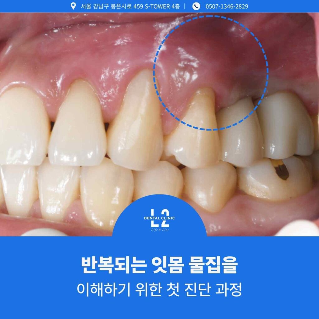 윗잇몸에 물집처럼 부은 부위를 표시한 잇몸염증고름 임상 사진