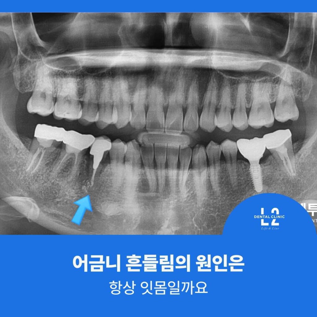 어금니 흔들림 원인을 확인하기 위한 파노라마 엑스레이 사진