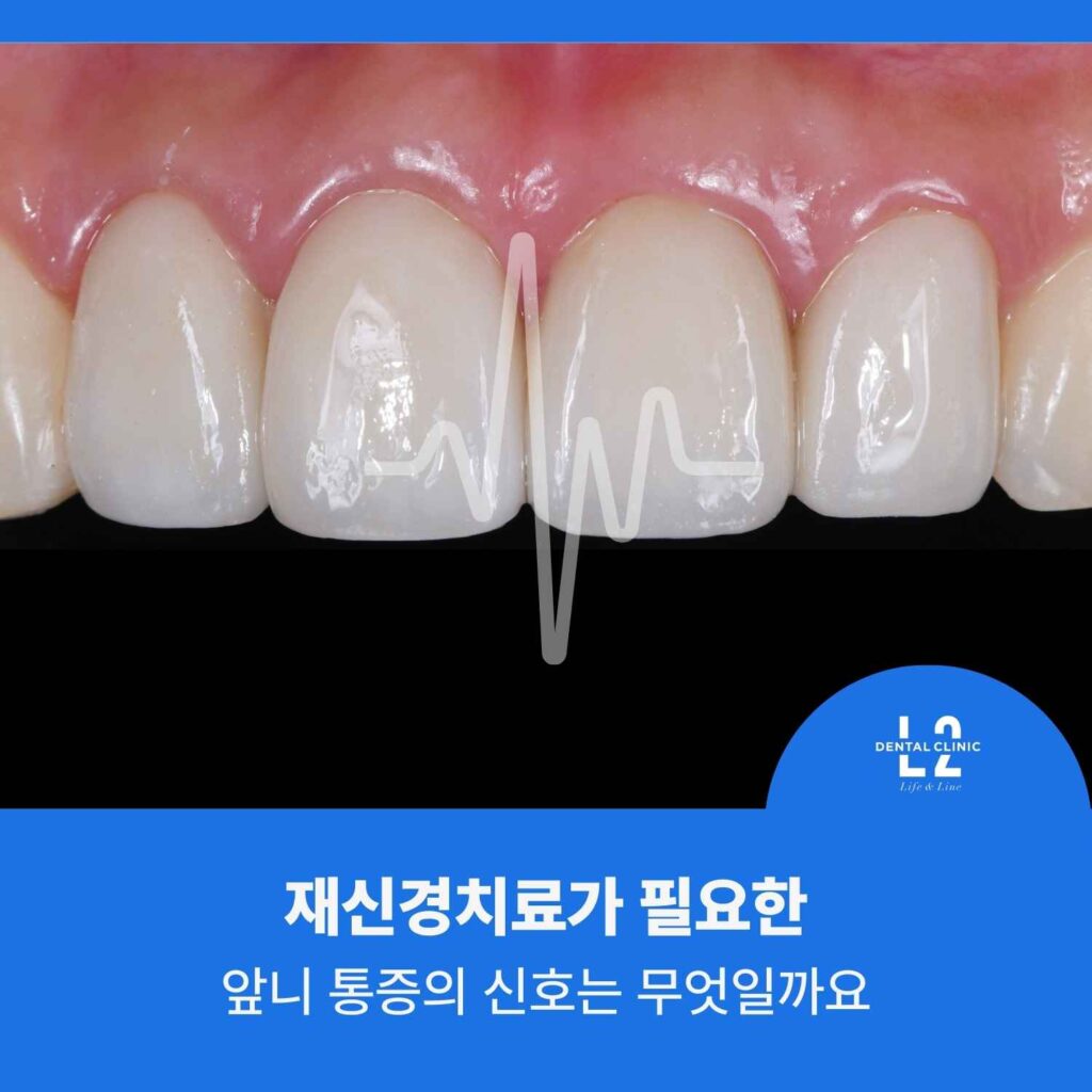 앞니 통증의 신호를 설명하기 위한 재신경치료 관련 앞니 정면 사진