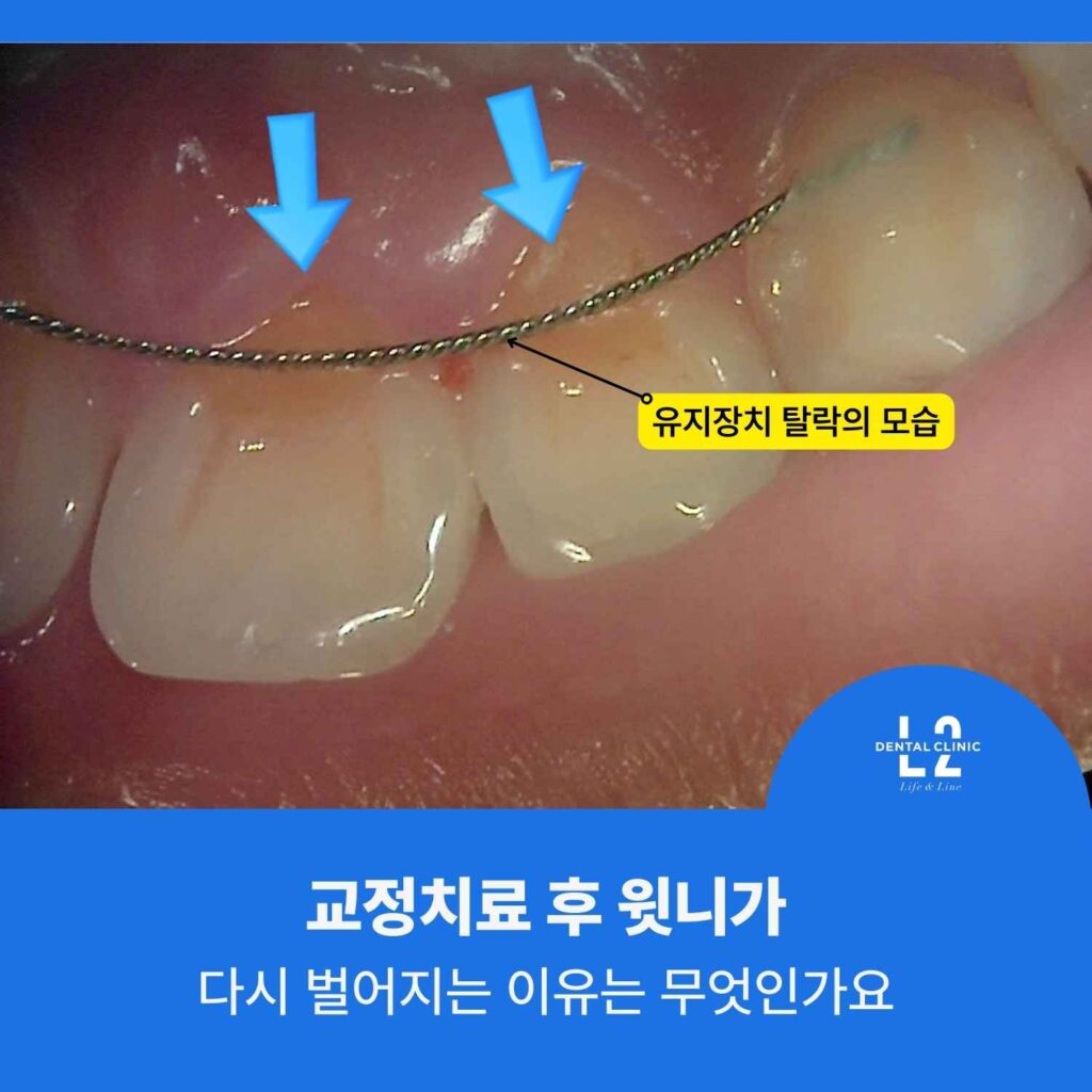 윗니교정 유지장치 탈락으로 치아가 다시 벌어진 모습