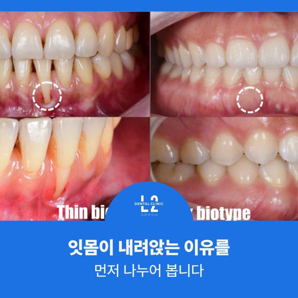 얇은 잇몸과 두꺼운 잇몸 바이오타입 차이를 비교한 구강 사진