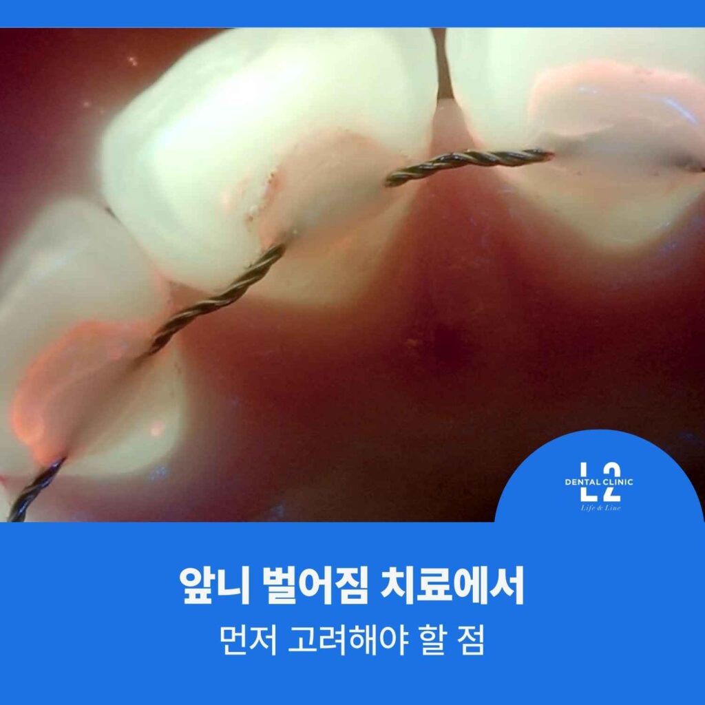 앞니 벌어짐 치료에서 교정적 접근을 고려해야 하는 이유를 보여주는 구강 사진