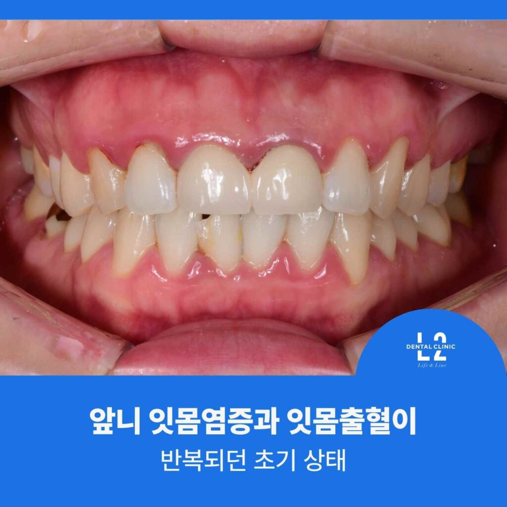 앞니 잇몸이 붉고 부어 보이는 상태 사진과 ‘앞니 잇몸염증과 잇몸출혈이 반복되던 초기 상태’ 문구.