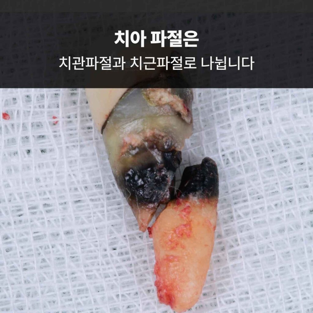 치관파절과 치근파절이 발생한 발치된 어금니 사진