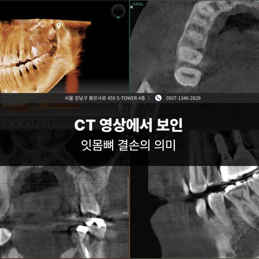 CT 영상에서 확인되는 잇몸뼈 결손과 관련 구조를 보여주는 치과 CT 이미지