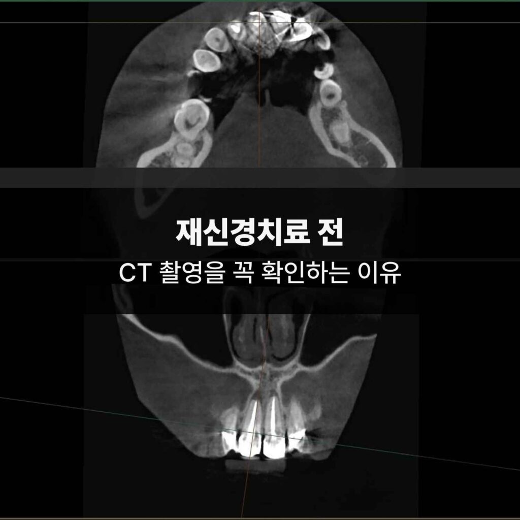 재신경치료 전 치아뿌리염증 확인을 위한 치과 CT 영상