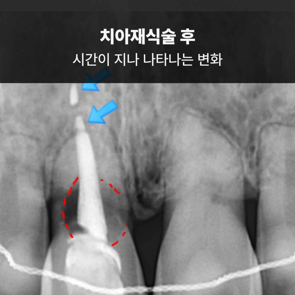 치아재식술 후 시간이 지나며 발생한 치근흡수 소견을 보여주는 엑스레이