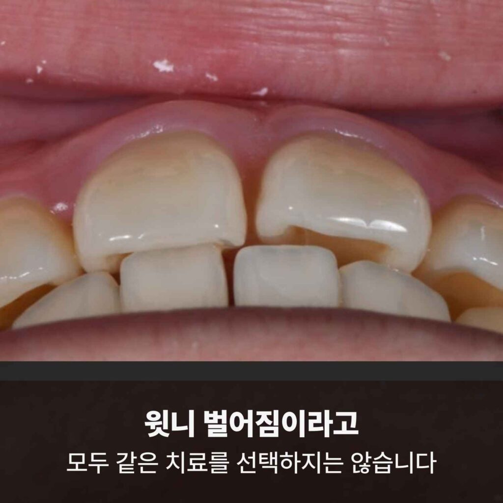 윗니 앞니 사이가 벌어진 상태의 교정 전 모습