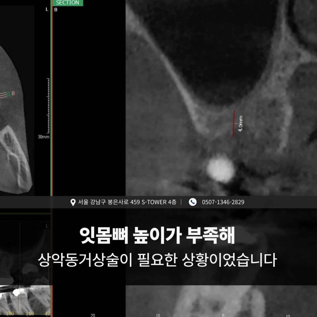 CT 단면 이미지에서 상악동과 잇몸뼈 높이가 부족한 부위를 표시한 화면.
