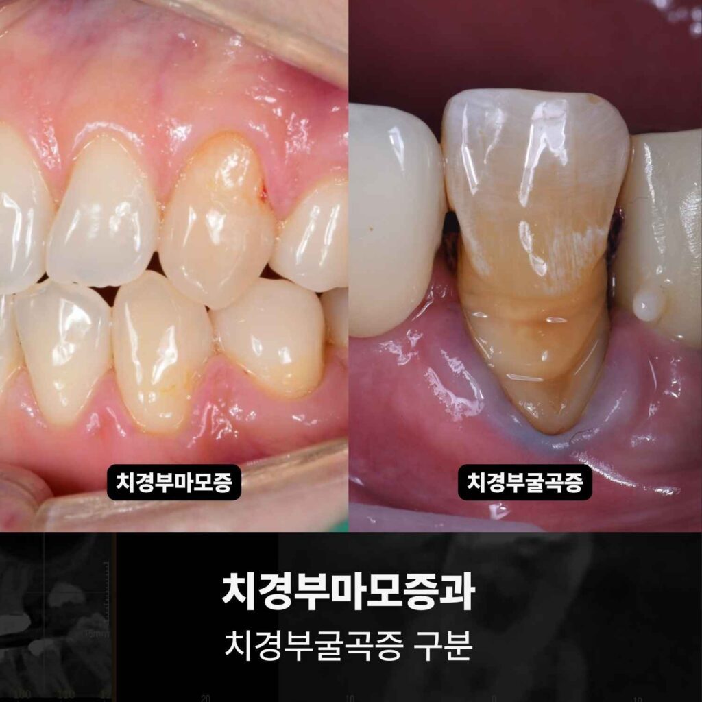 치경부마모증과 치경부굴곡증의 형태 차이를 비교한 치아 사진