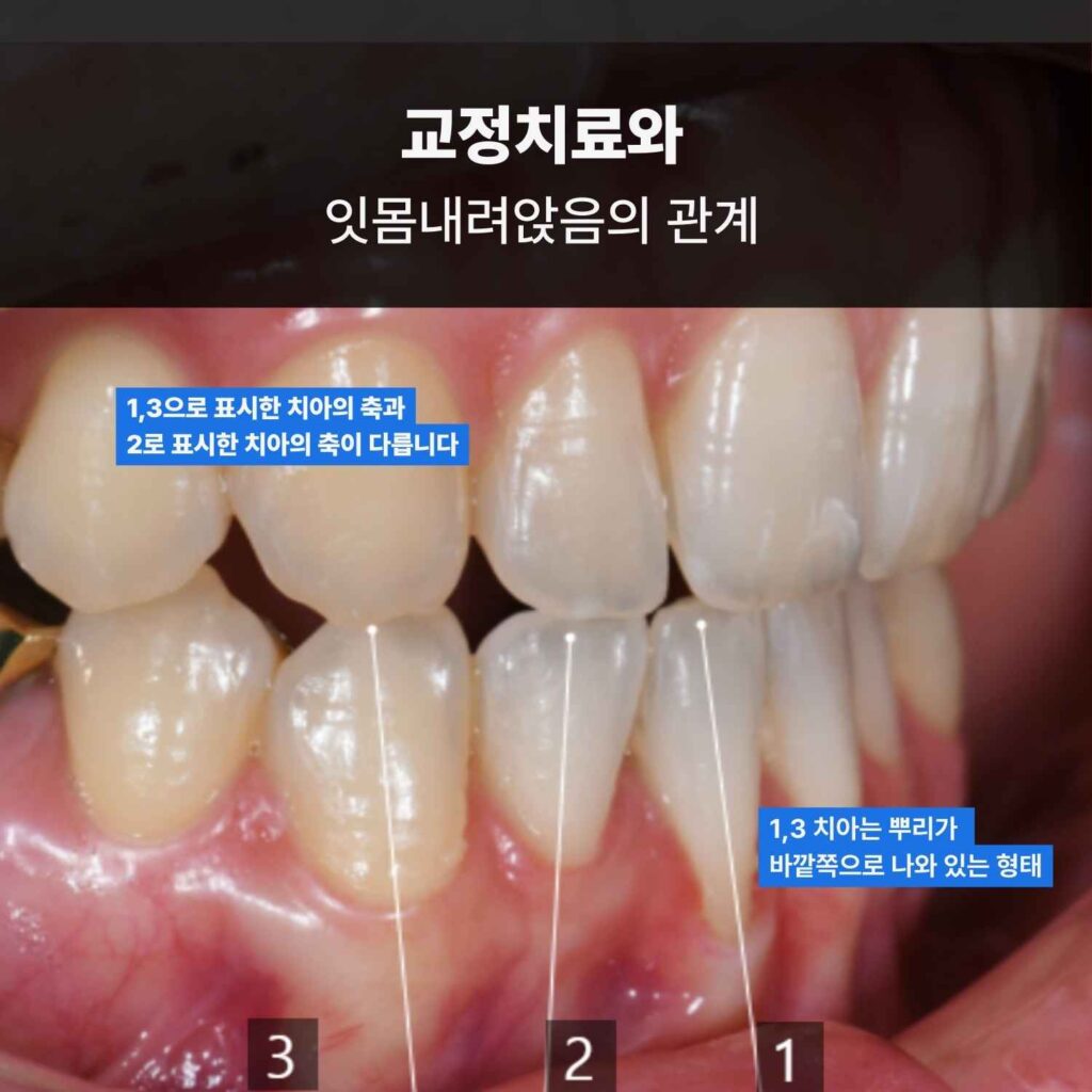 교정치료 후 치아 축 방향 차이로 잇몸이 내려앉아 보이는 모습