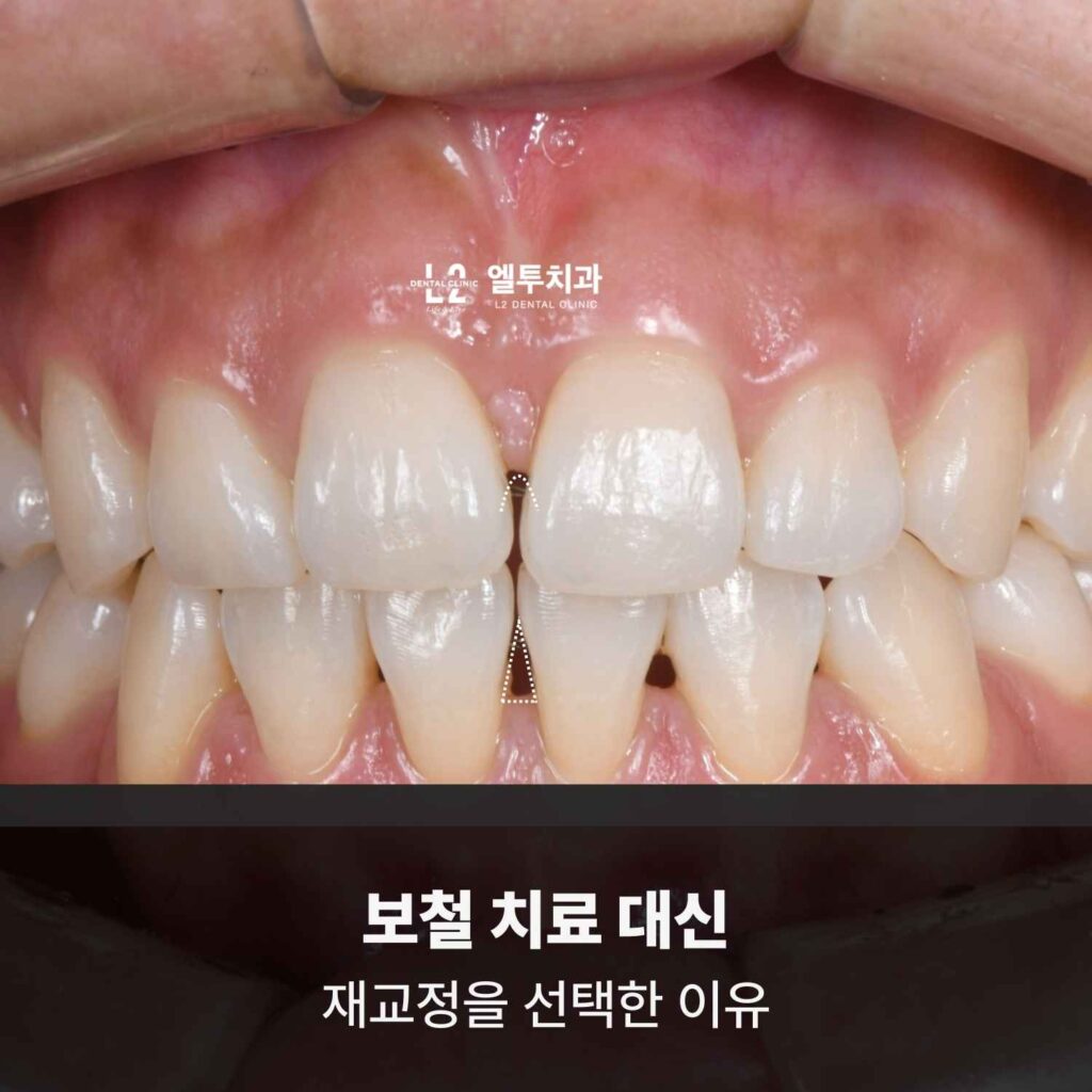 보철 치료 대신 재교정을 선택한 앞니 벌어짐 치료 전 상태