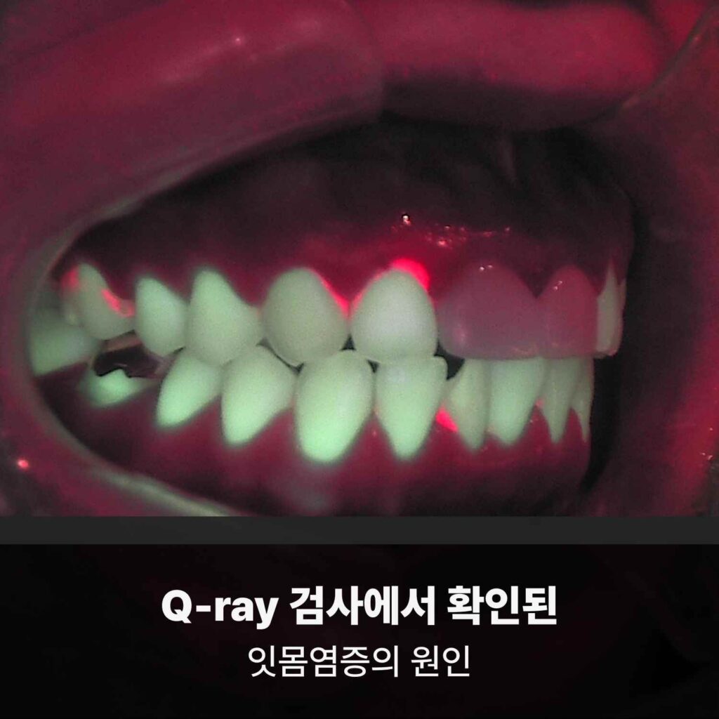 Q-ray 촬영으로 붉은 형광 반응이 보이는 구강 사진과 ‘Q-ray 검사에서 확인된 잇몸염증의 원인’ 문구.