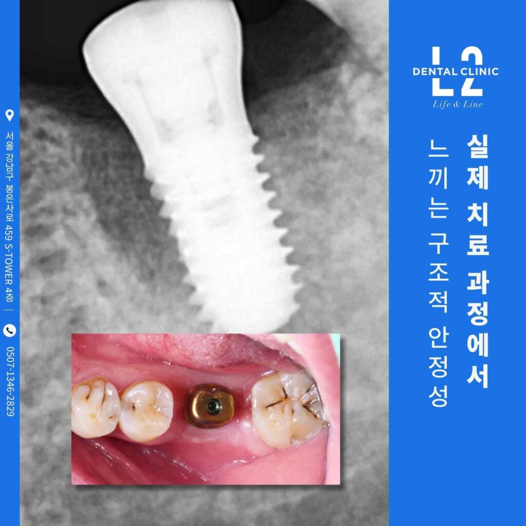 티슈레벨 임플란트 식립 후 구강 내 사진과 X-ray를 함께 보여주는 임상 이미지