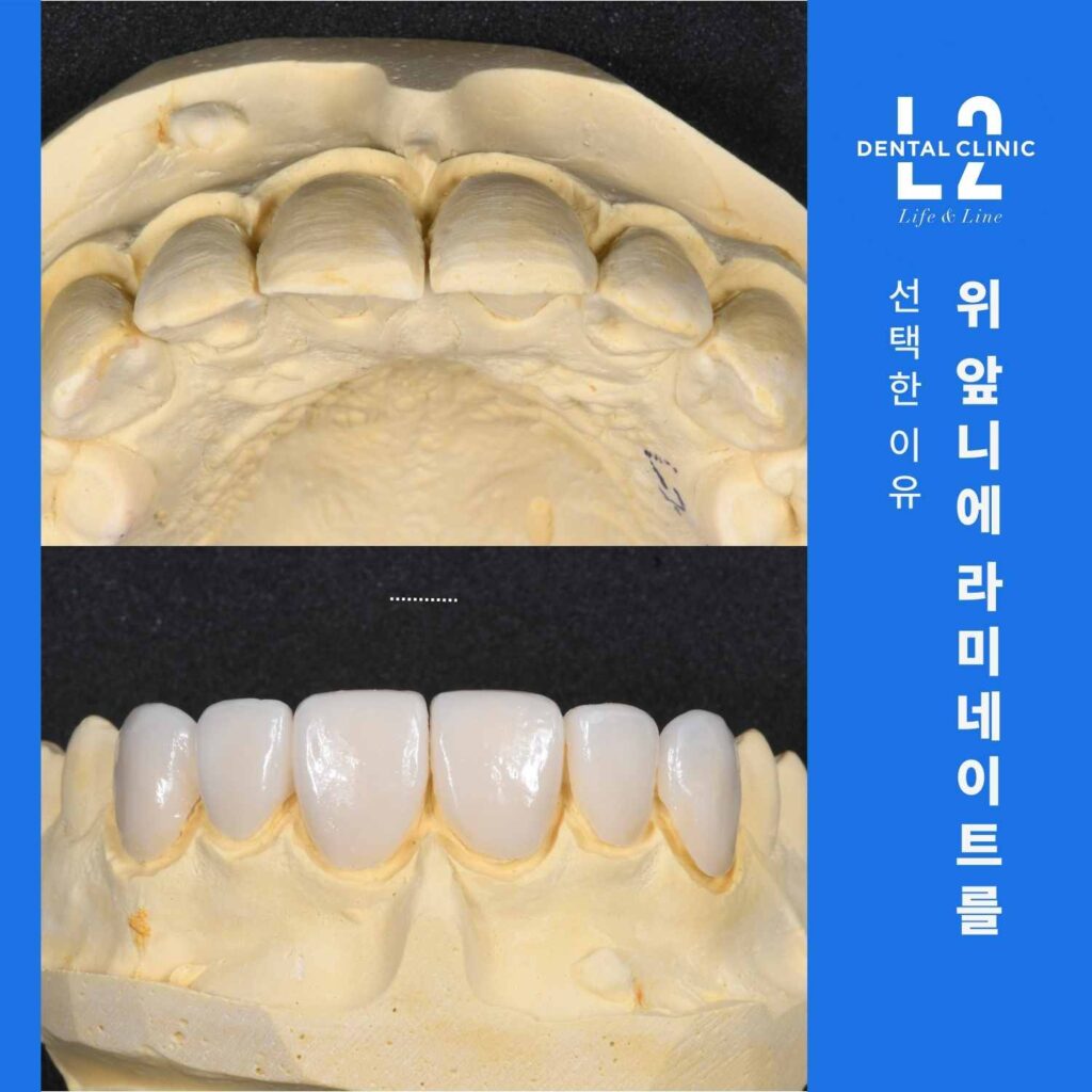 앞니 라미네이트 제작을 위해 모형에서 치아 형태를 조정한 모습