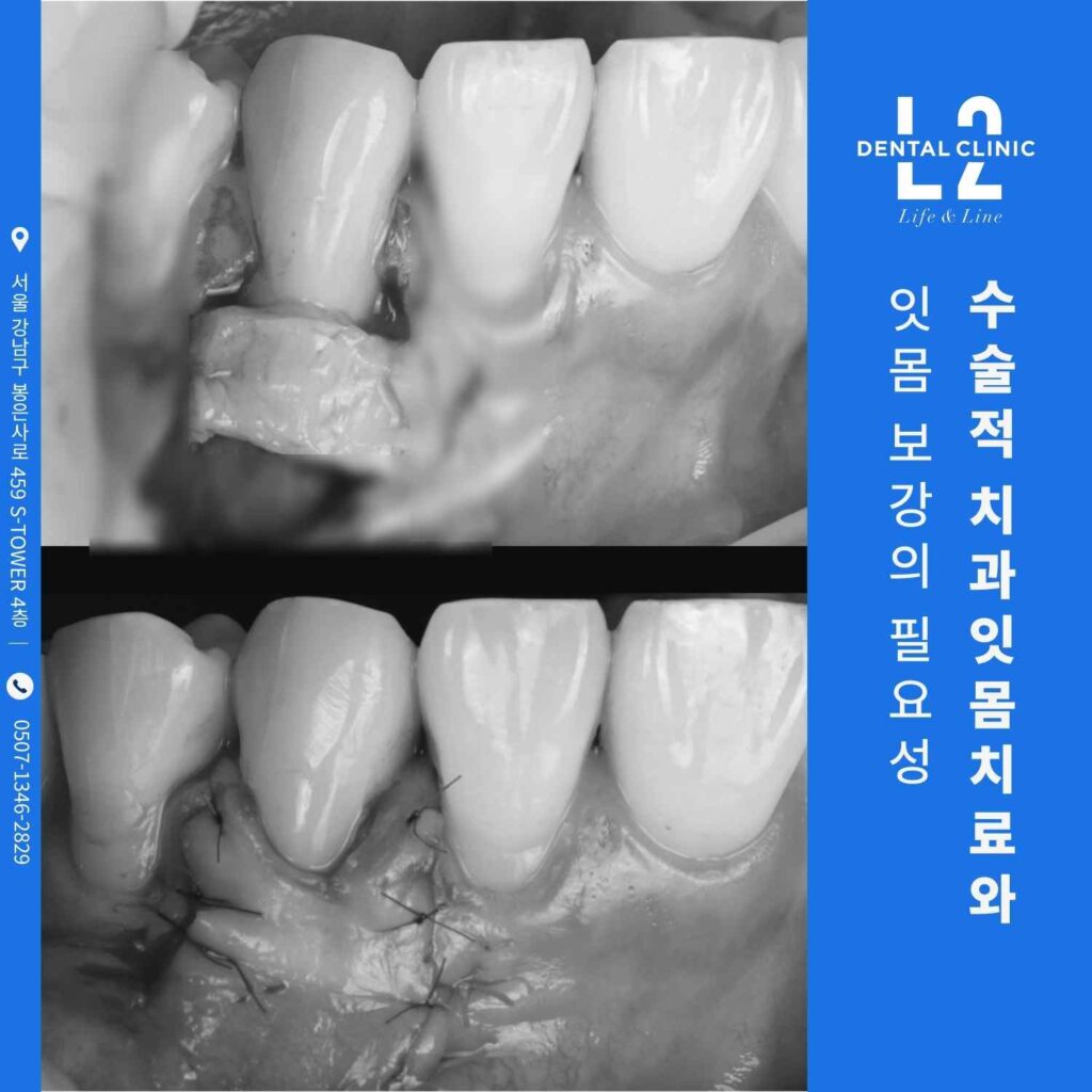 치은박리소파술과 잇몸 보강 과정에서 촬영한 수술 전후 임상 사진