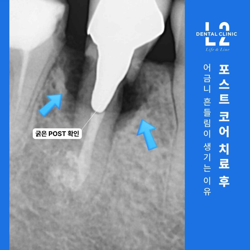 포스트 코어 치료 후 치근 파절이 확인된 어금니 엑스레이 사진