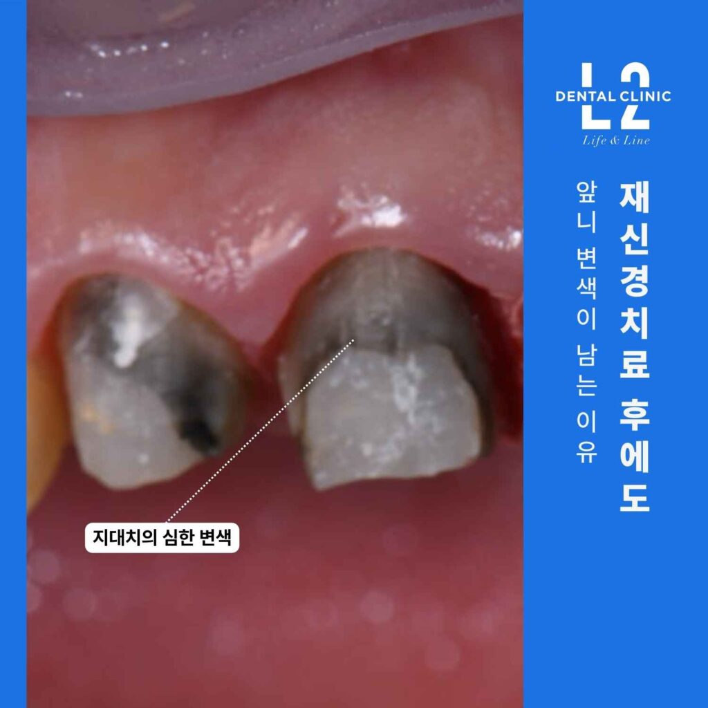 재신경치료 후 확인된 앞니 지대치의 심한 변색 사진