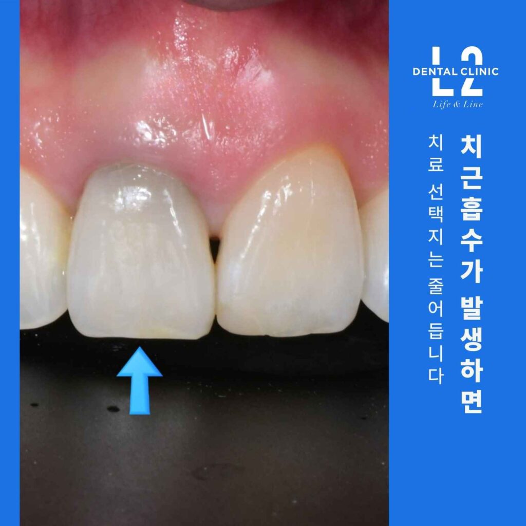 치아재식술 후 치근흡수로 인해 형태 변화가 나타난 앞니 임상 사진