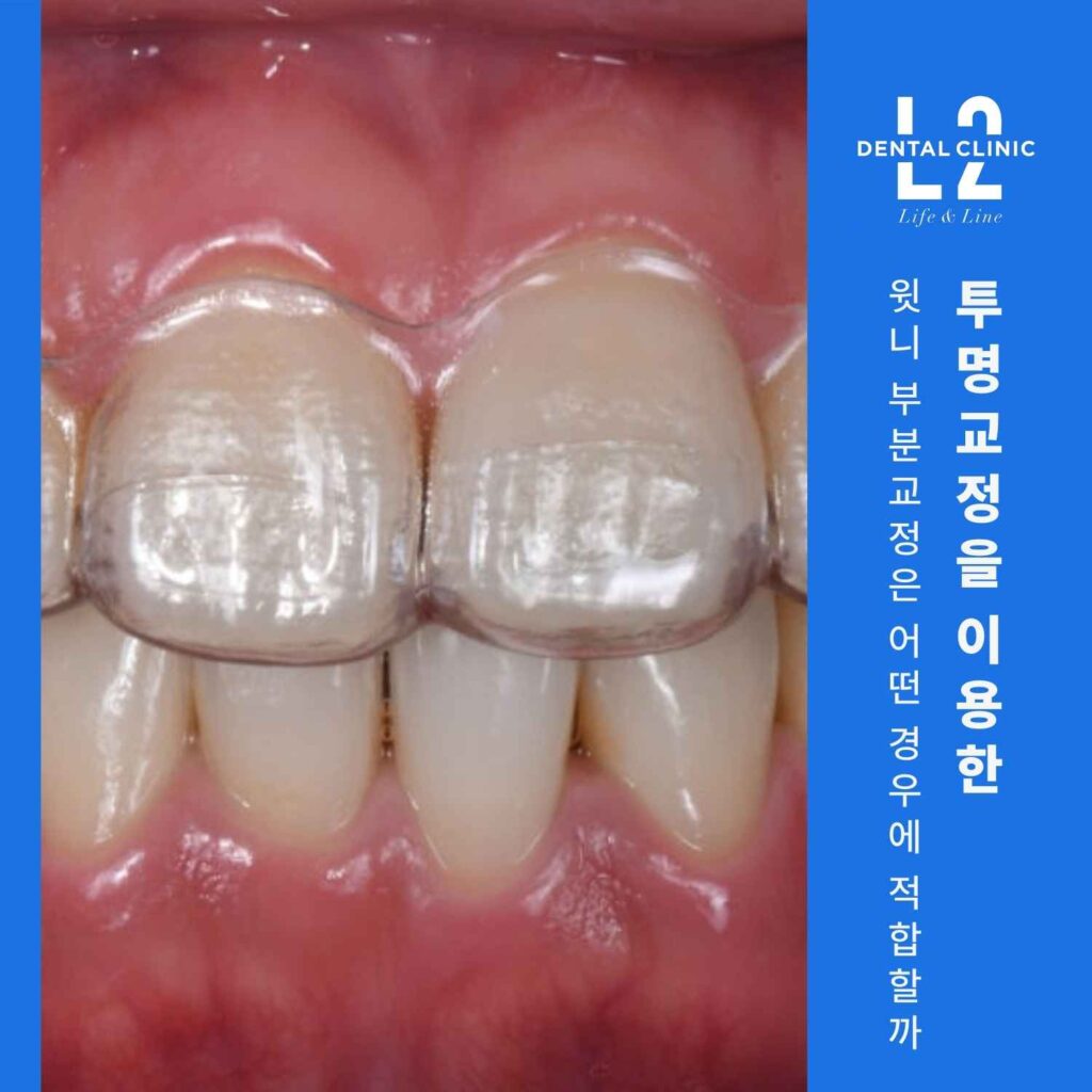 윗니 부분교정을 위한 투명교정 장치 착용 모습
