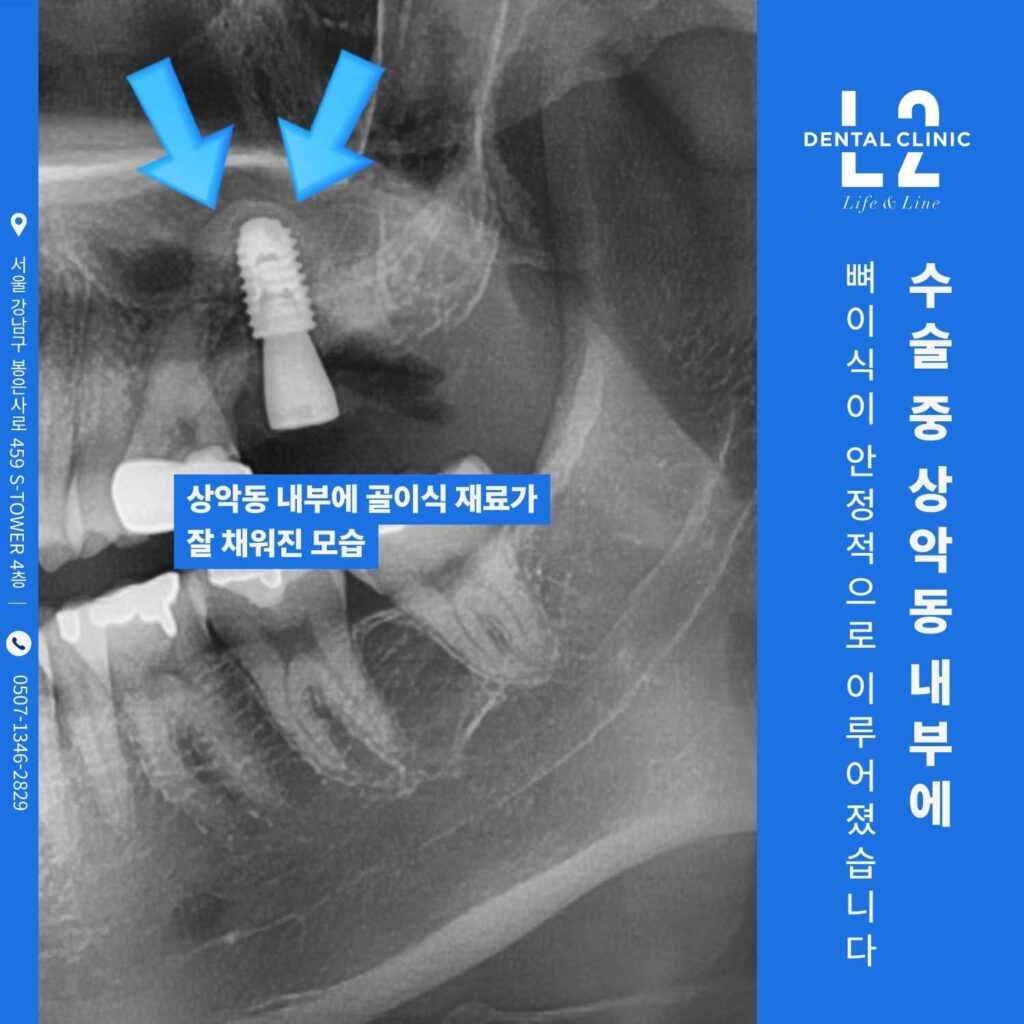 수술 중 상악동 내부에 뼈이식 재료가 채워진 모습이 엑스레이로 표현된 이미지.