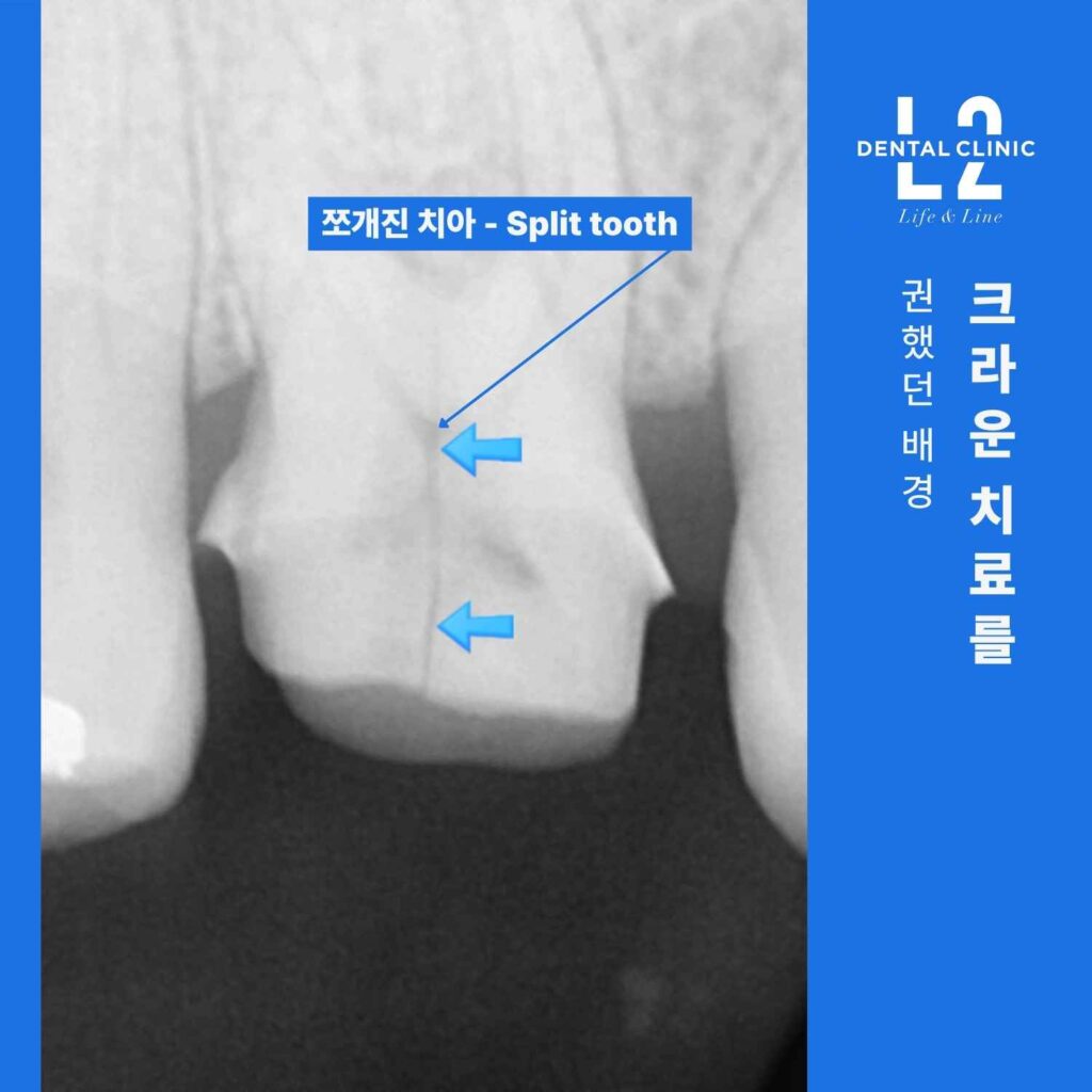 X-ray에서 확인된 치아의 수직 균열과 split tooth 상태를 표시한 영상 이미지