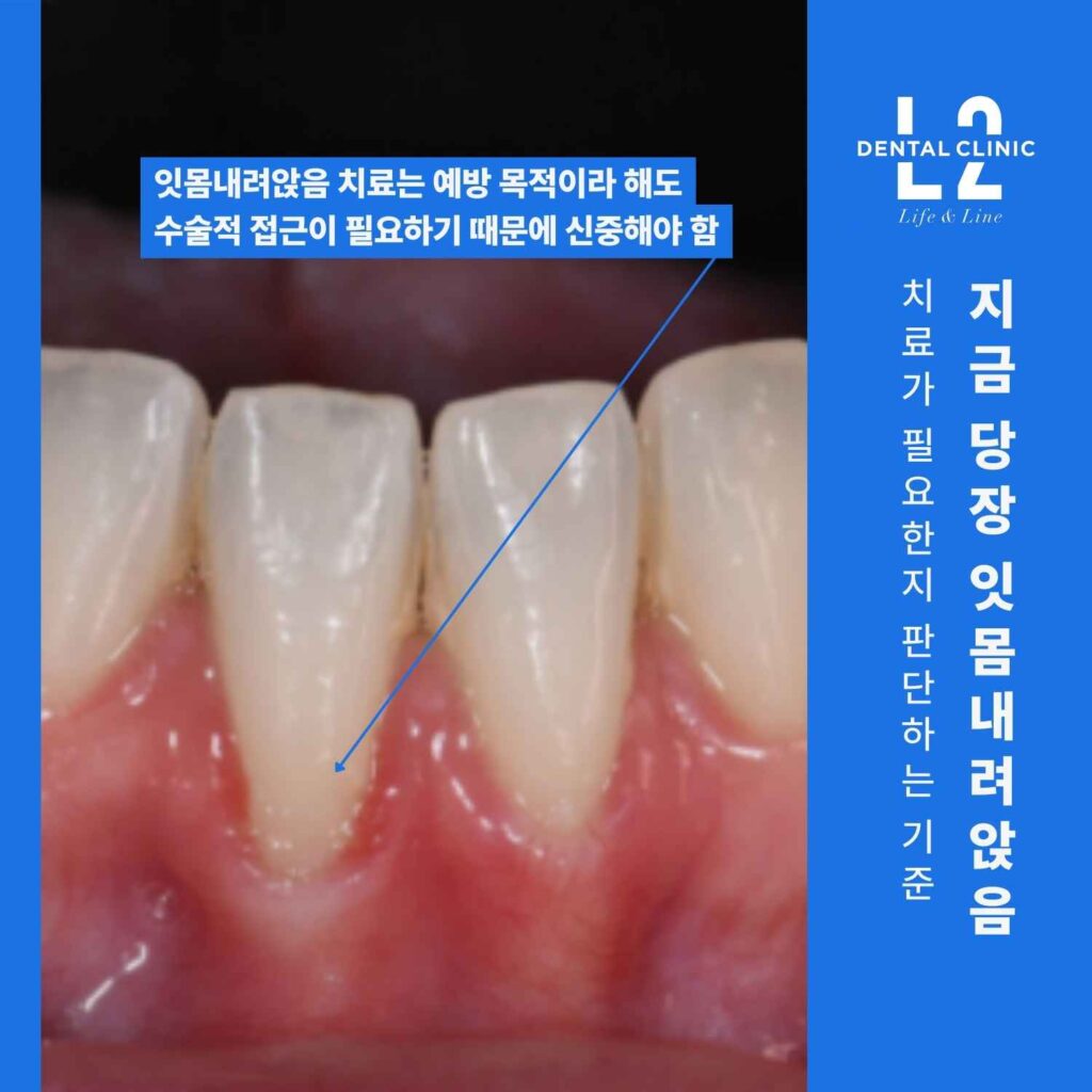 아래 앞니 부위 잇몸퇴축과 치료 필요성을 설명한 구강 사진