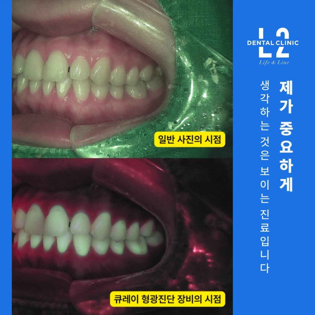 일반 구강 사진과 큐레이 형광진단 장비로 촬영한 비교 이미지