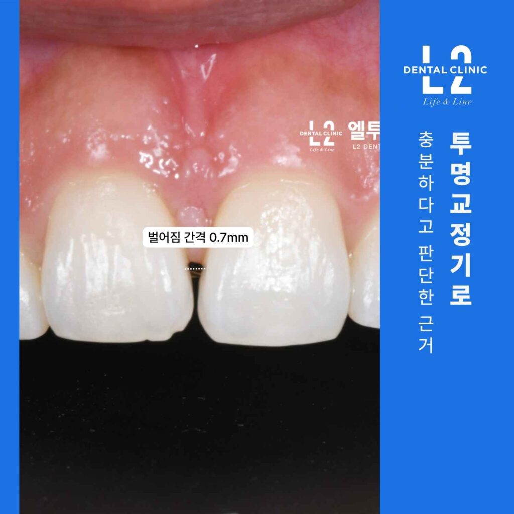 앞니 사이 벌어짐 간격 0.7mm를 측정한 임상 사진